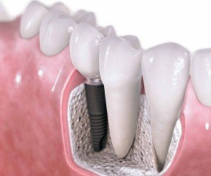 implantes-dentales2